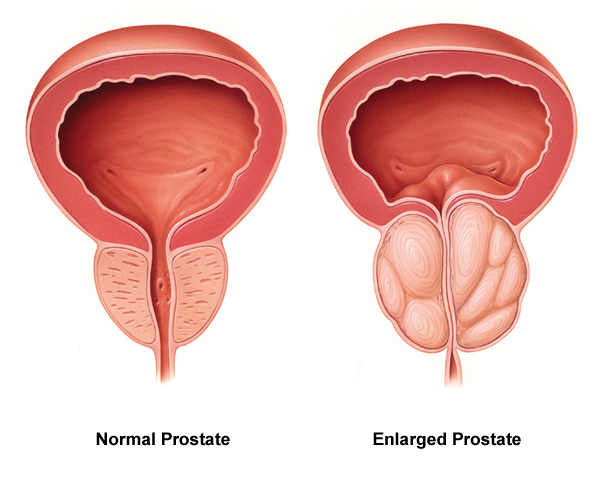psa prostata